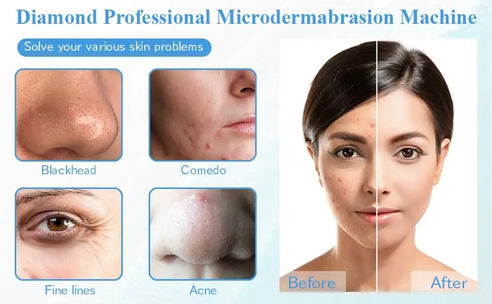Diamond Microdermabrasion Machine